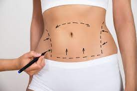 Non Surgical Liposuction In Chandigarh